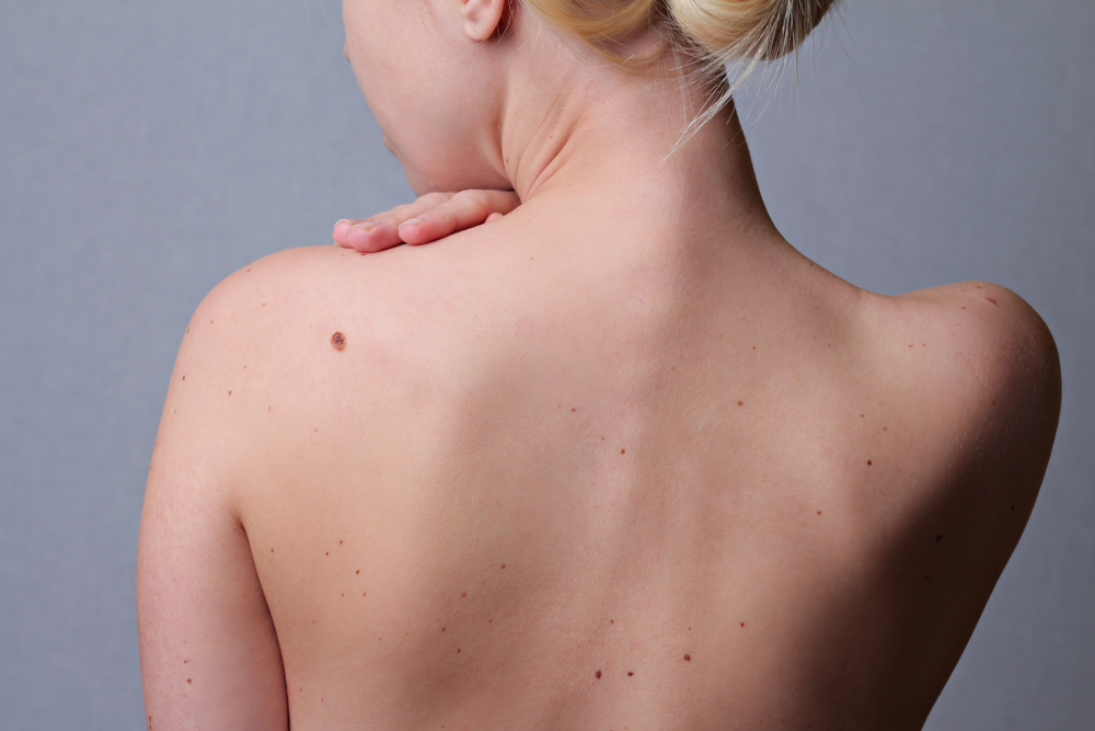 How I Learned to Be Comfortable With My Beauty Marks