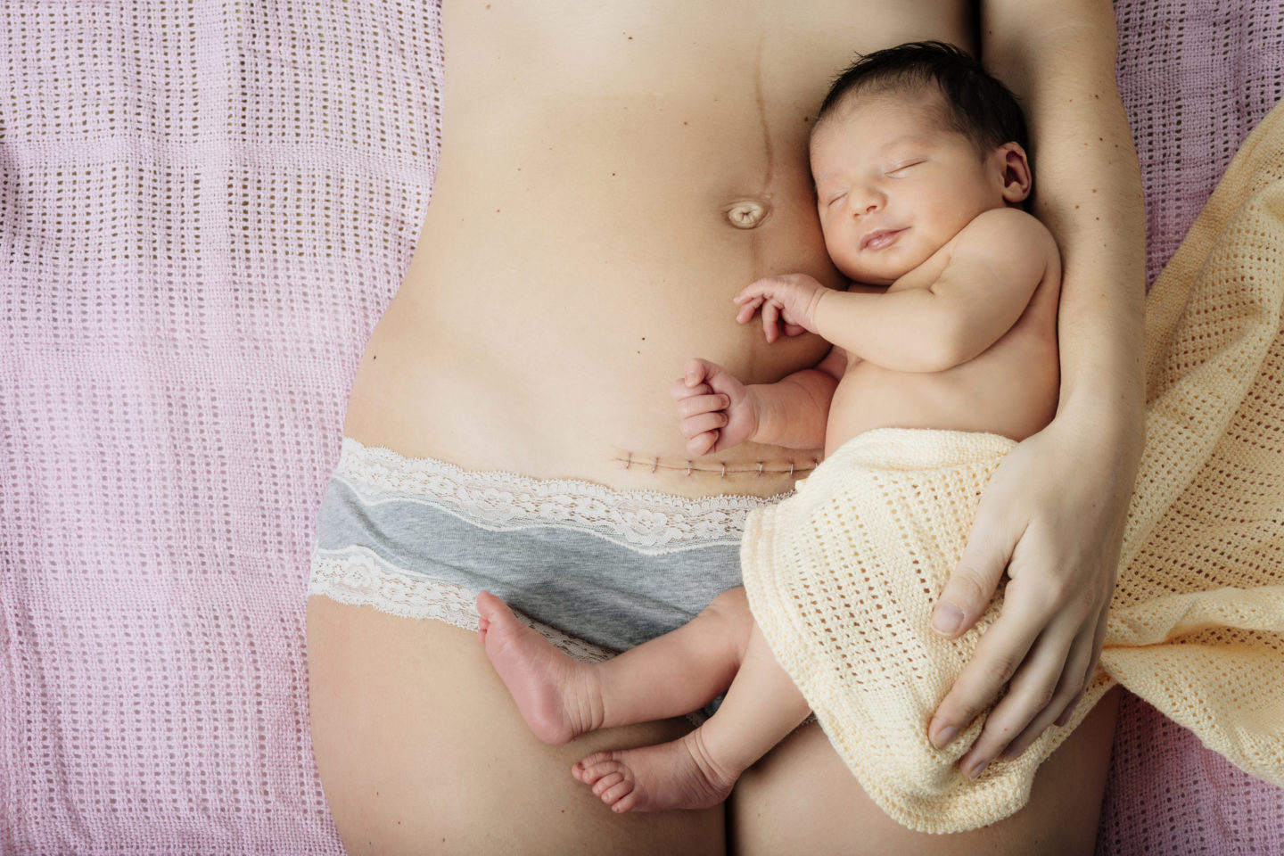 Here’s Why These Women Want You To Stop Shaming Them For Their C-section