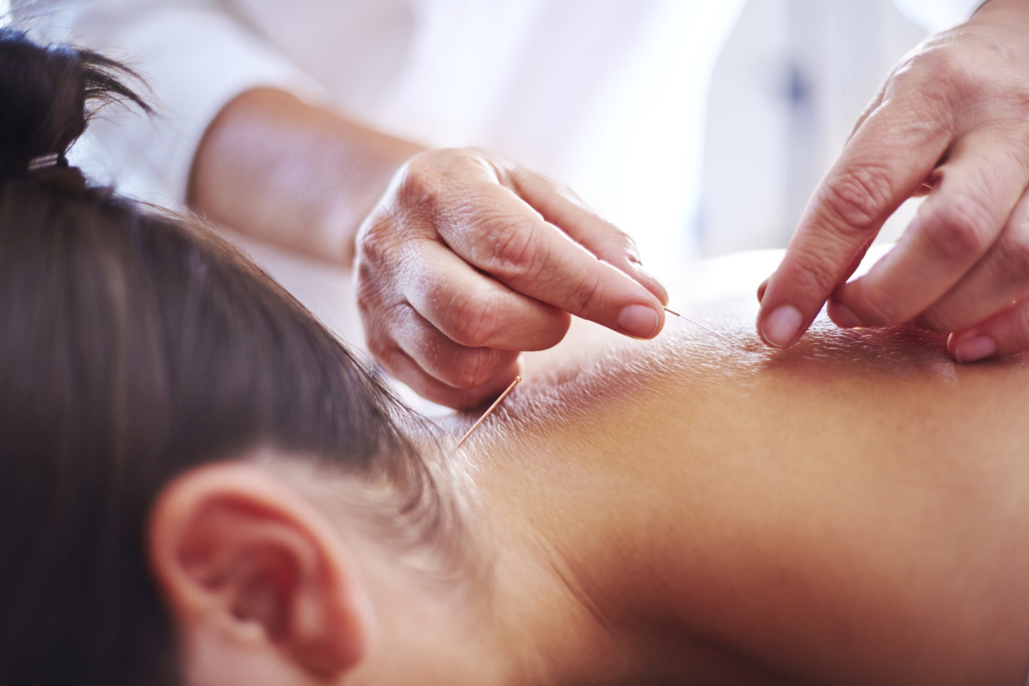 Can Acupuncture Help Treat Women’s Health Issues?